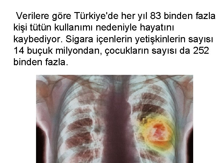  Verilere göre Türkiye'de her yıl 83 binden fazla kişi tütün kullanımı nedeniyle hayatını