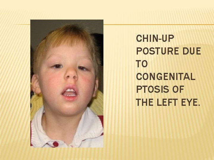 CHIN-UP POSTURE DUE TO CONGENITAL PTOSIS OF THE LEFT EYE. 
