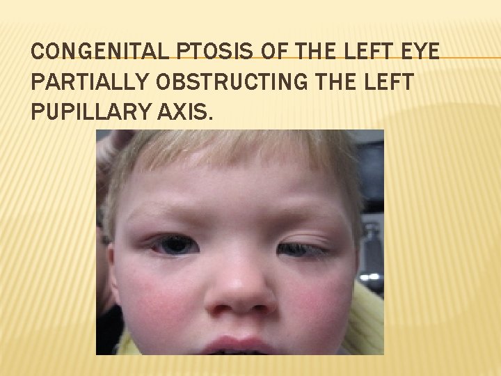 CONGENITAL PTOSIS OF THE LEFT EYE PARTIALLY OBSTRUCTING THE LEFT PUPILLARY AXIS. 