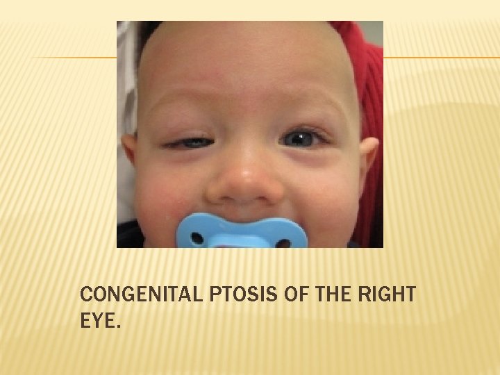 CONGENITAL PTOSIS OF THE RIGHT EYE. 