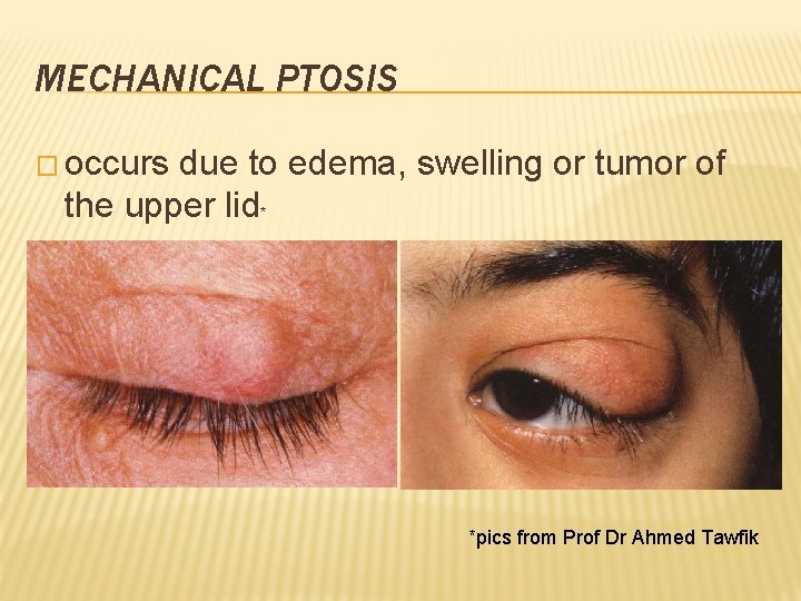 MECHANICAL PTOSIS � occurs due to edema, swelling or tumor of the upper lid