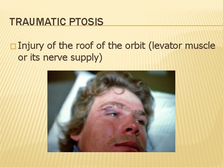 TRAUMATIC PTOSIS � Injury of the roof of the orbit (levator muscle or its