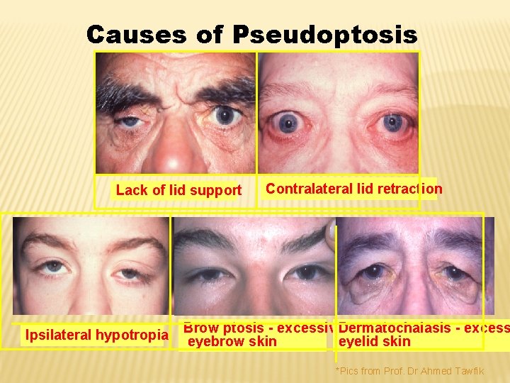 Causes of Pseudoptosis Lack of lid support Ipsilateral hypotropia Contralateral lid retraction Brow ptosis