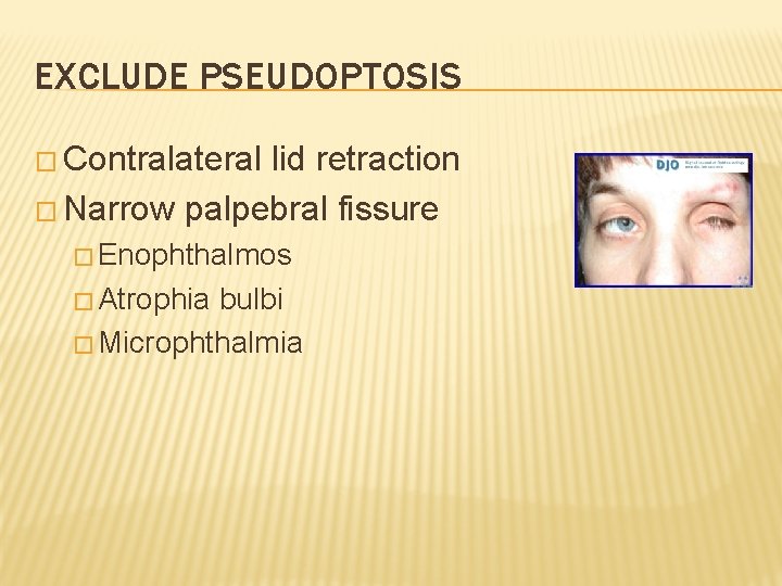 EXCLUDE PSEUDOPTOSIS � Contralateral lid retraction � Narrow palpebral fissure � Enophthalmos � Atrophia