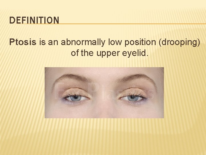 DEFINITION Ptosis is an abnormally low position (drooping) of the upper eyelid. 