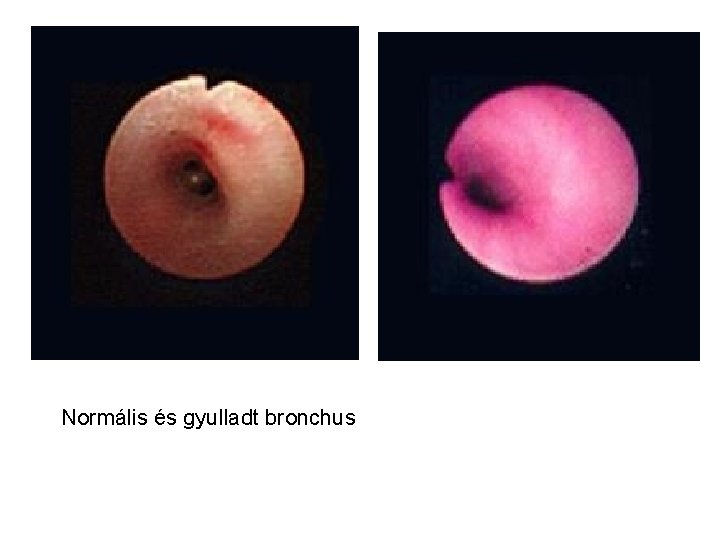 Normális és gyulladt bronchus 