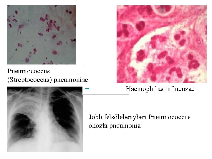 Pneumococcus (Streptococcus) pneumoniae Haemophilus influenzae Jobb felsőlebenyben Pneumococcus okozta pneumonia 