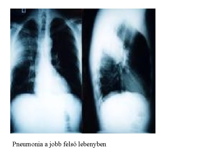 Pneumonia a jobb felső lebenyben 