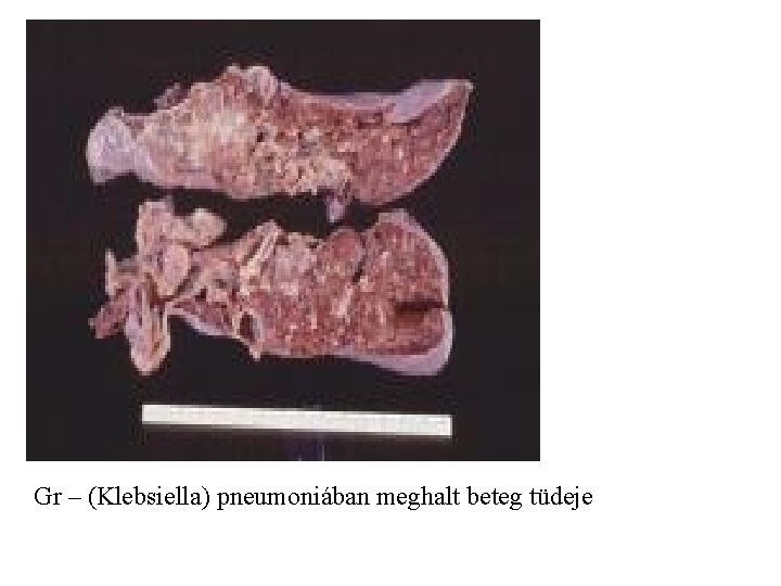  Gr – (Klebsiella) pneumoniában meghalt beteg tüdeje 