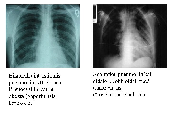 Bilateralis interstitialis pneumonia AIDS –ben Pneuocystitis carini okozta (opportunista kórokozó) Aspiratios pneumonia bal oldalon.