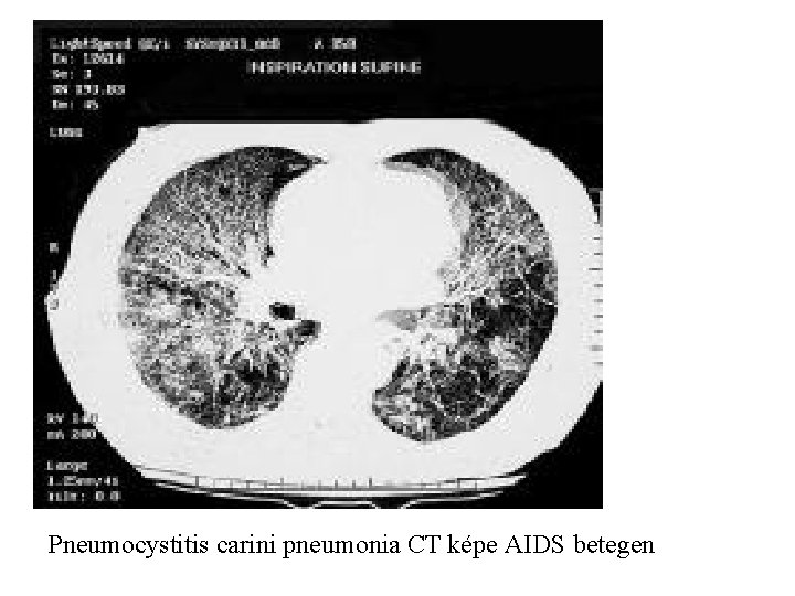  Pneumocystitis carini pneumonia CT képe AIDS betegen 