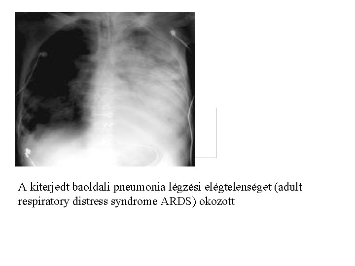  A kiterjedt baoldali pneumonia légzési elégtelenséget (adult respiratory distress syndrome ARDS) okozott 