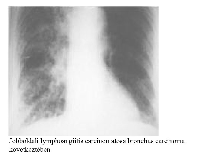  Jobboldali lymphoangiitis carcinomatosa bronchus carcinoma következtében 