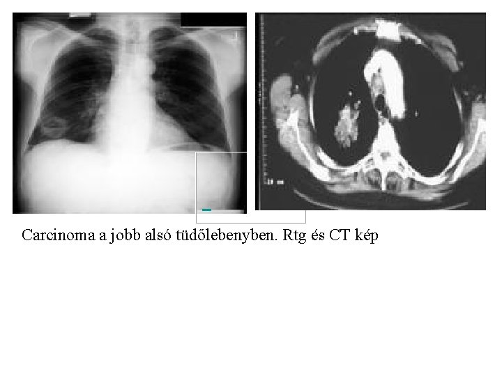  Carcinoma a jobb alsó tüdőlebenyben. Rtg és CT kép 