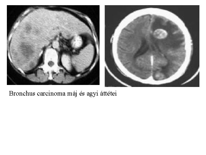 Bronchus carcinoma máj és agyi áttétei 