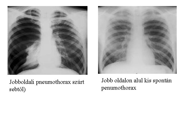 Jobboldali pneumothorax szúrt sebtől) Jobb oldalon alul kis spontán penumothorax 