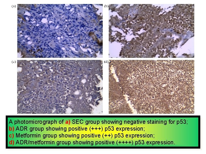 A photomicrograph of a) SEC group showing negative staining for p 53; b) ADR