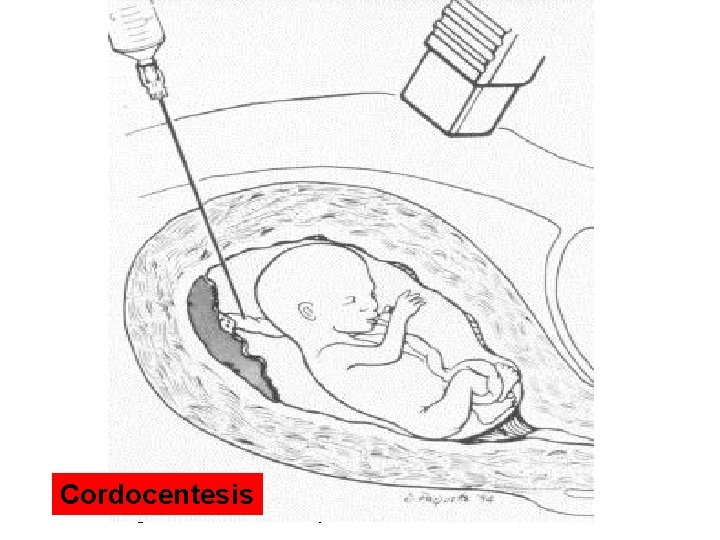 Cordocentesis Diagram of cordocentesis procedure 
