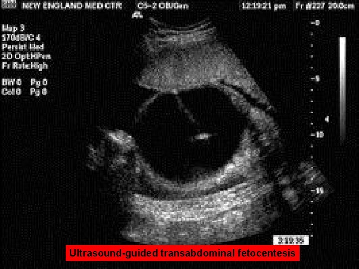 Ultrasound-guided transabdominal fetocentesis 