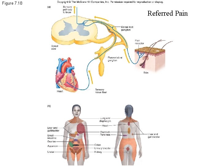 Figure 7. 18 Referred Pain 