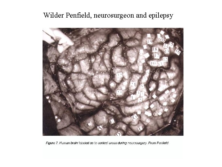 Wilder Penfield, neurosurgeon and epilepsy 