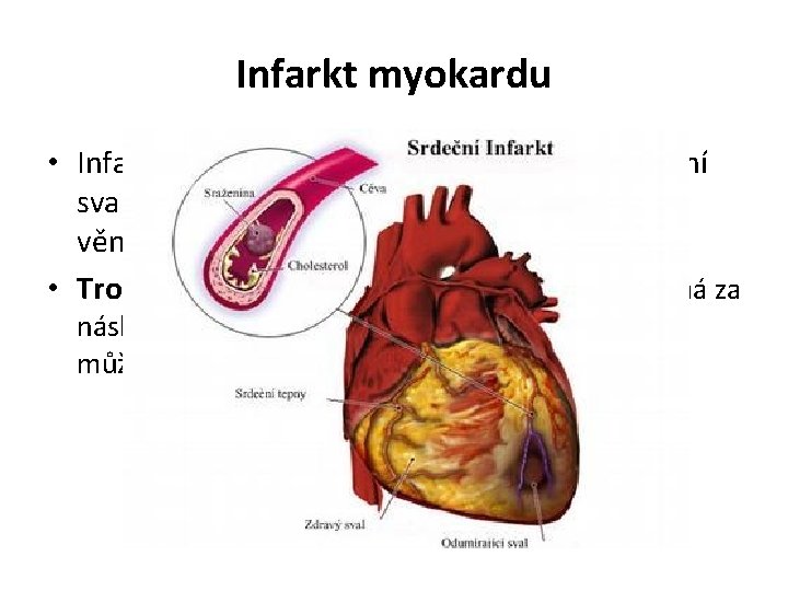 Infarkt myokardu • Infarkt myokardu je náhlé odúmrtí části srdeční svaloviny, obvykle je způsobeno