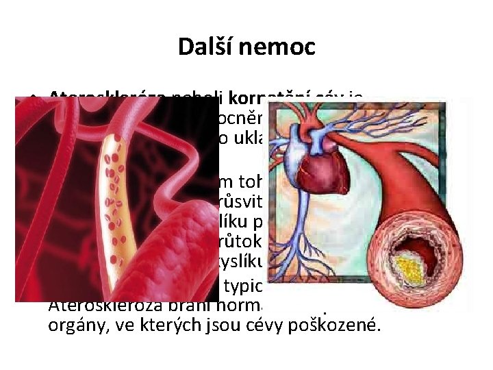 Další nemoc • Ateroskleróza neboli kornatění cév je degenerativní onemocnění tepen. Vzniká v důsledku