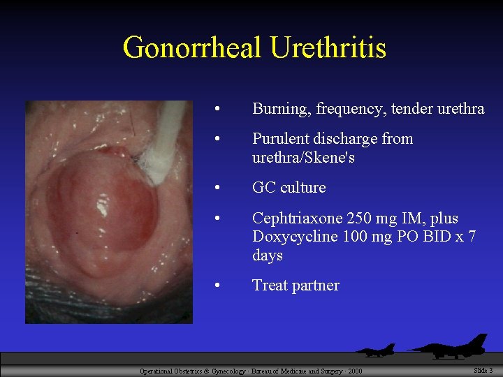 Gonorrheal Urethritis • Burning, frequency, tender urethra • Purulent discharge from urethra/Skene's • GC