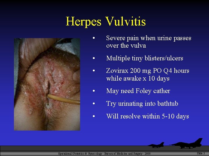 Herpes Vulvitis • Severe pain when urine passes over the vulva • Multiple tiny