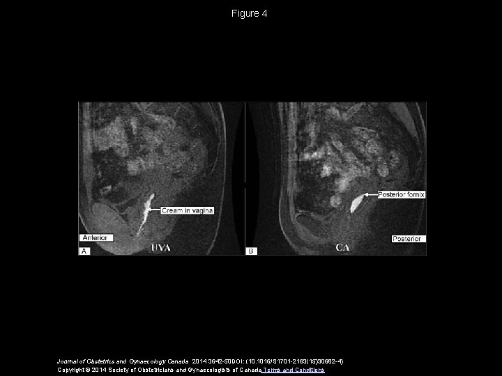 Figure 4 Journal of Obstetrics and Gynaecology Canada 2014 3642 -50 DOI: (10. 1016/S