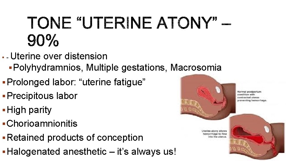 §- Uterine over distension § Polyhydramnios, Multiple gestations, Macrosomia § Prolonged labor: “uterine fatigue”