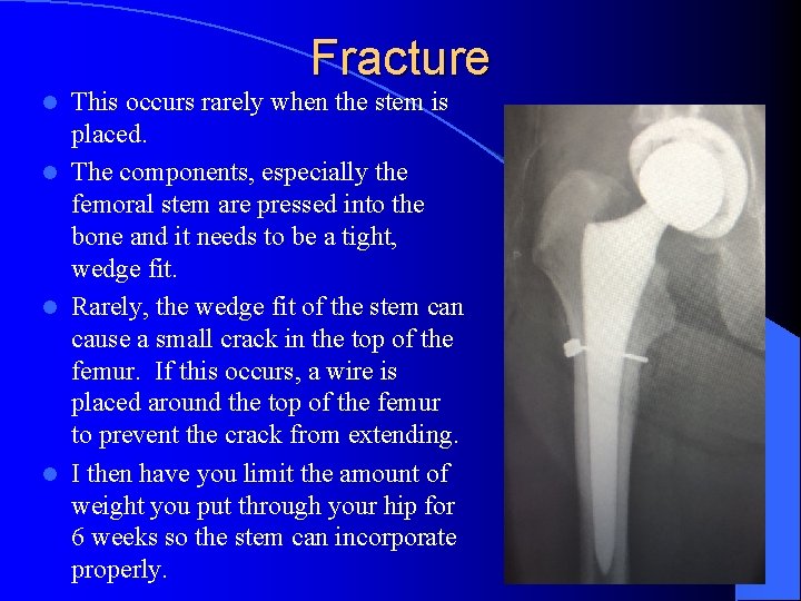 Fracture This occurs rarely when the stem is placed. l The components, especially the