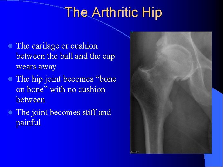 Understanding Total Hip Replacement Brian J White MD