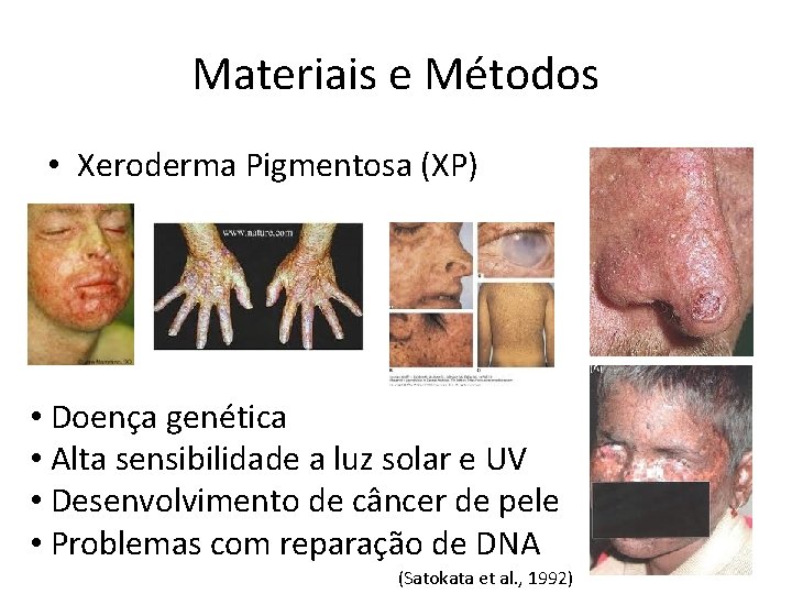 Materiais e Métodos • Xeroderma Pigmentosa (XP) • Doença genética • Alta sensibilidade a