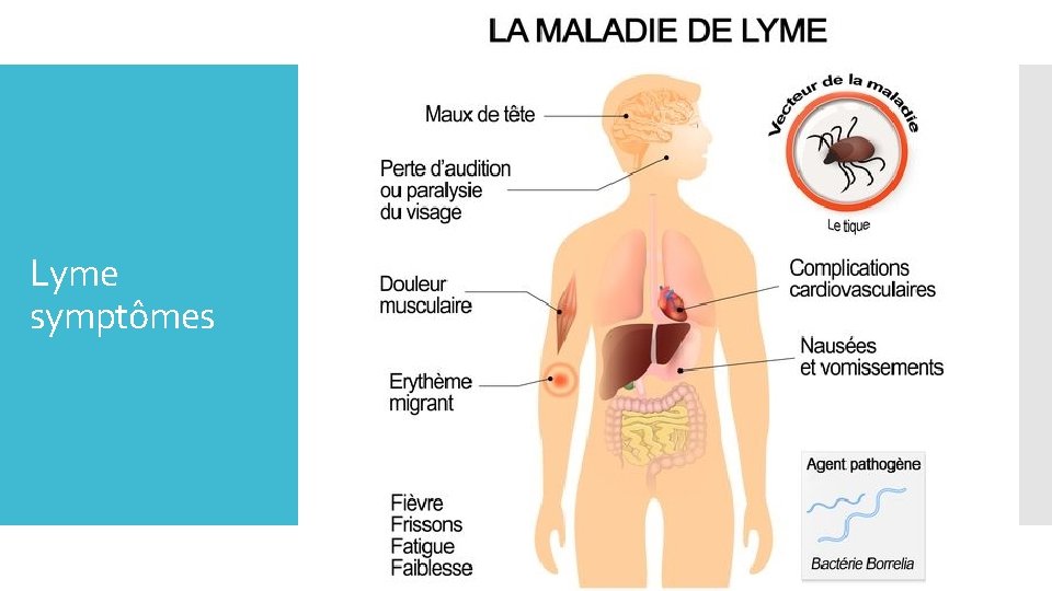 Lyme symptômes 