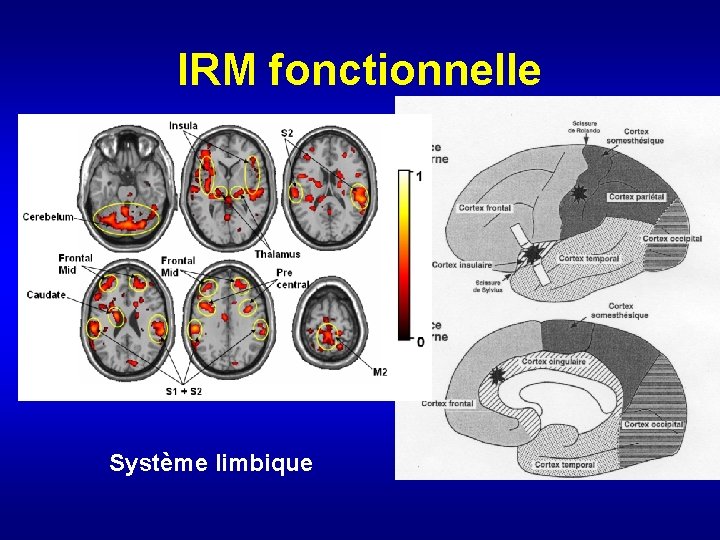 IRM fonctionnelle Système limbique 