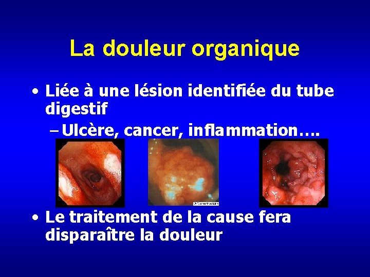 La douleur organique • Liée à une lésion identifiée du tube digestif – Ulcère,