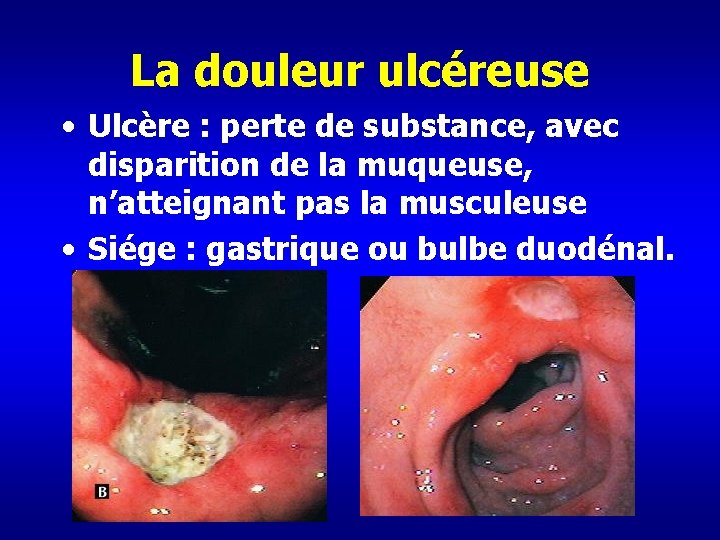 La douleur ulcéreuse • Ulcère : perte de substance, avec disparition de la muqueuse,