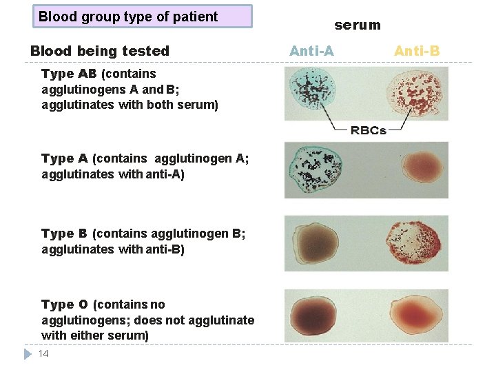 Blood group type of patient Blood being tested Type AB (contains agglutinogens A and
