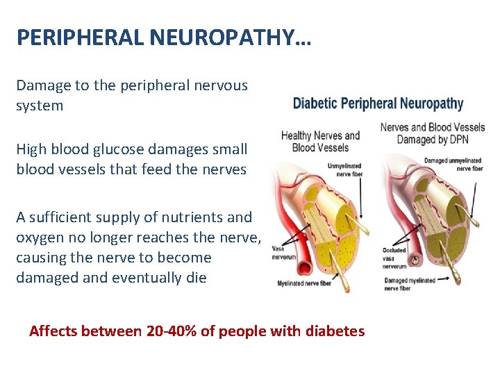 PERIPHERAL NEUROPATHY… Damage to the peripheral nervous system High blood glucose damages small blood