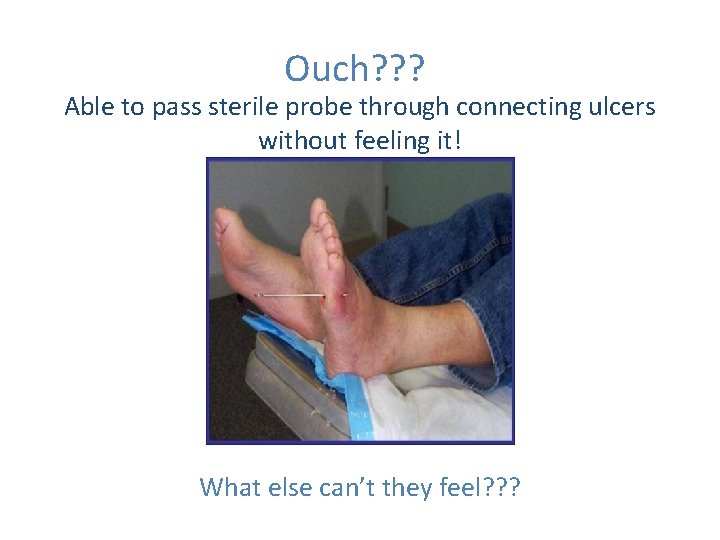 Ouch? ? ? Able to pass sterile probe through connecting ulcers without feeling it!