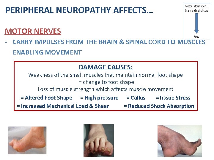 PERIPHERAL NEUROPATHY AFFECTS… MOTOR NERVES - CARRY IMPULSES FROM THE BRAIN & SPINAL CORD