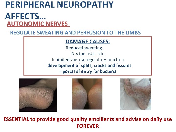 PERIPHERAL NEUROPATHY AFFECTS… AUTONOMIC NERVES - REGULATE SWEATING AND PERFUSION TO THE LIMBS DAMAGE