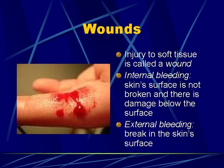 Wounds Injury to soft tissue is called a wound Internal bleeding: skin’s surface is