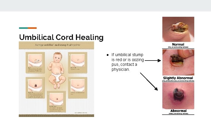 Umbilical Cord Healing ● If umbilical stump is red or is oozing pus, contact