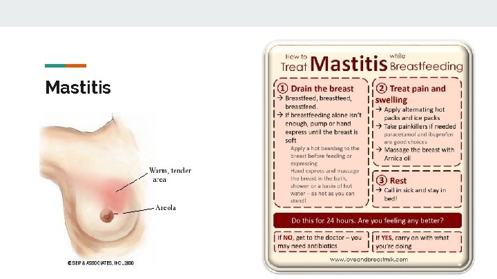 Mastitis 