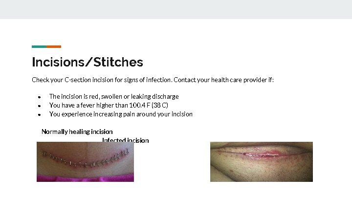 Incisions/Stitches Check your C-section incision for signs of infection. Contact your health care provider