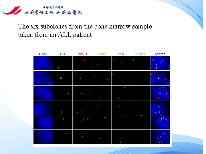 The six subclones from the bone marrow sample taken from an ALL patient 