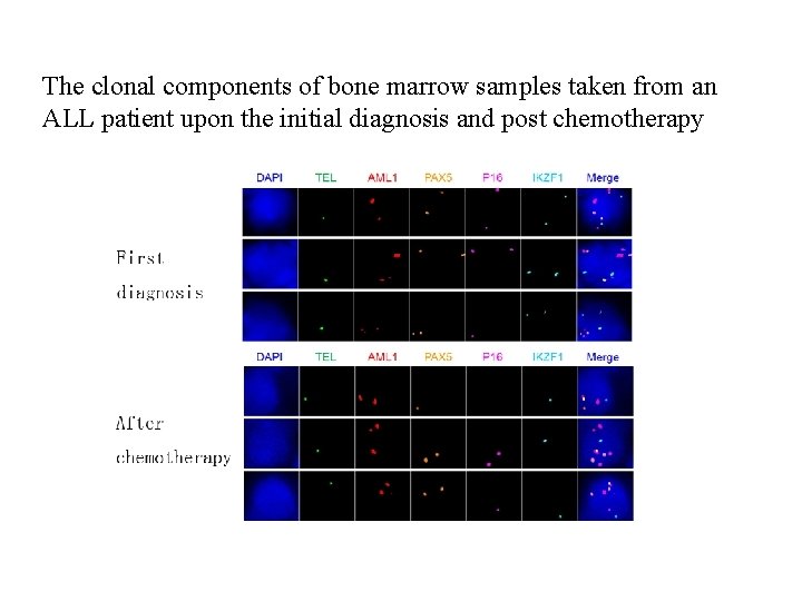 The clonal components of bone marrow samples taken from an ALL patient upon the
