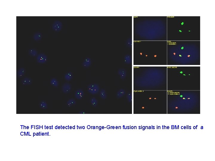 The FISH test detected two Orange-Green fusion signals in the BM cells of a
